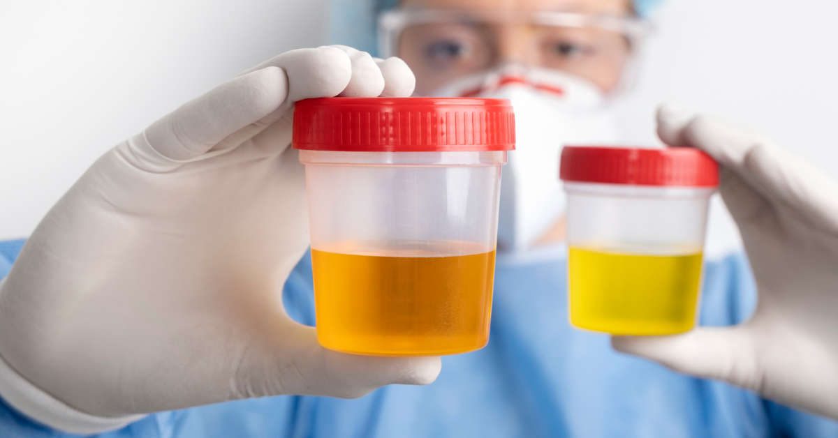 Erytrocyty w moczu w ciąży – co oznaczają, norma, diagnoza