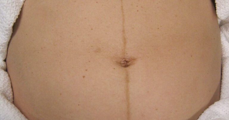 Kreska na brzuchu w ciąży – czym jest linea nigra?