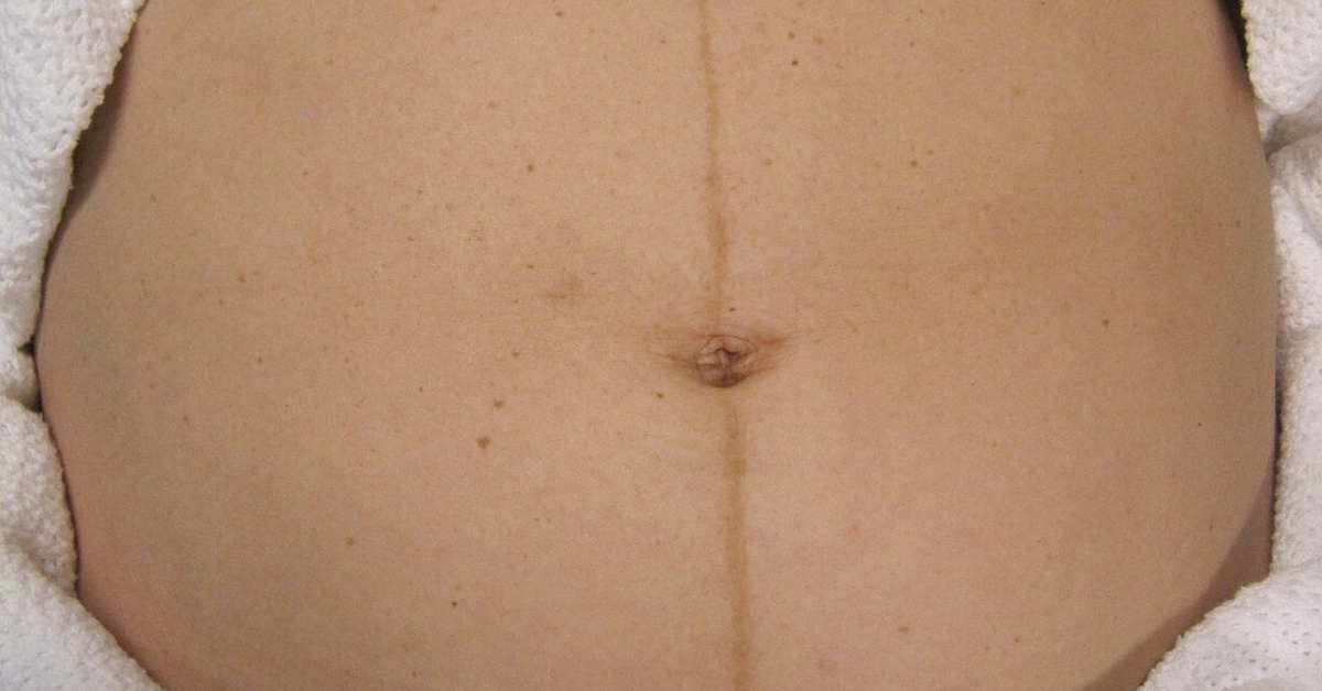 Kreska na brzuchu w ciąży – czym jest linea nigra?