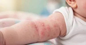 Zbliżenie na ramię niemowlęcia z widoczną czerwoną wysypką na delikatnej skórze w miękkim świetle dziennym.